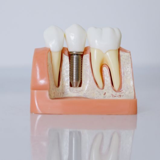 dental-implant