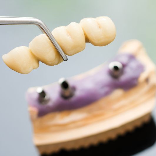 dentalbridge