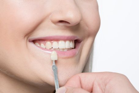 porcelain-veneer